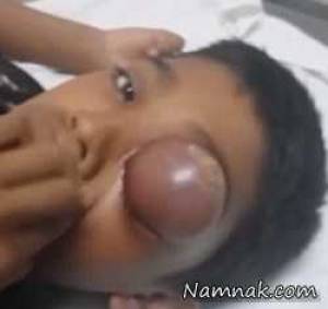 جراحی تخلیه چندش اور کیست و بزرگترین گل مژه روی چشم یک کودک