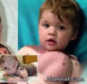 کاشت پستان به پسربچه 4 ساله