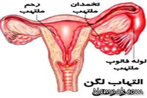 عفونت لگن یا بیماری التهابی لگن در زنان