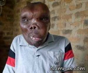 زندگی سخت مردی با سندرم فیبرودیسپلازیا :