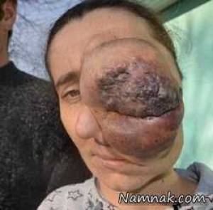تومور چشم نیمی از صورت زن جوان را پوشاند