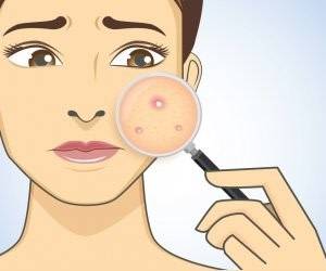 چطور باید جوش های صورت را از بین برد؟