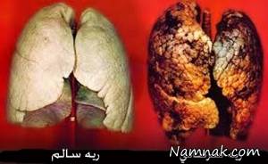 تشخیص سرطان ریه با یک روش نوین