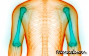 بیماری عجیب و غریب اسکلتی به نام استخوان زایی