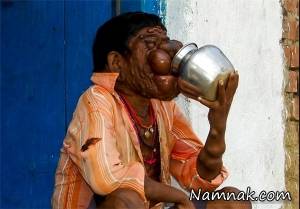 تومورهای بیشمار در بدن پسر هندی