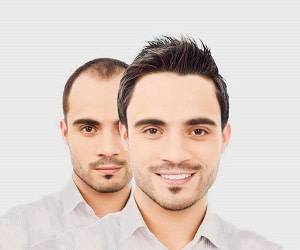 بهترین سن برای کاشت مو چه زمانی است؟