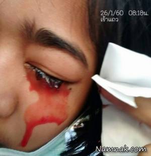 &nbsp;دختری که به جای عرق، خون از بدنش خارج می شود