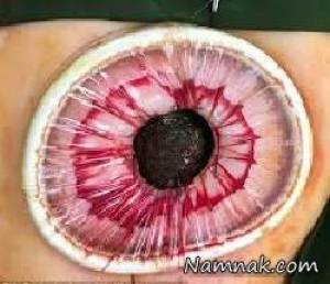 خارج کردن غول دم بلند مویی از شکم دختر نوجوان هندی