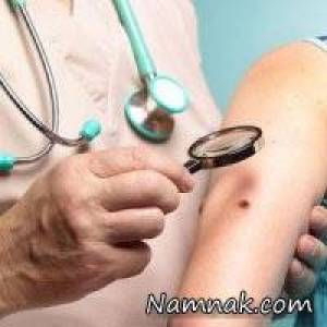 جلوگیری از گسترش مرگبارترین شکل سرطان پوست
