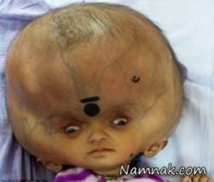 &nbsp;کودکی با بزرگترین سر دنیا جراحی شد