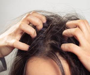 اگزما پوست سر چیست و چه علائمی دارد ؟