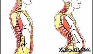 چگونه از گودی کمر جلوگیری کنیم