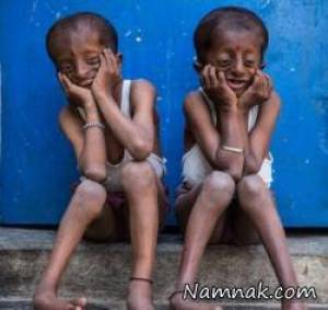 بیماری ناشناخته دو برادر آنها را در خانه زندانی کرده است