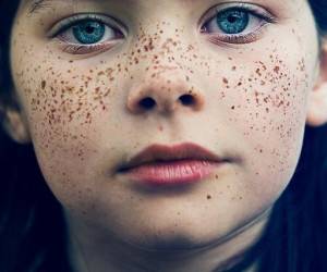 &nbsp;آنچه لازم است در مورد ضایعات پیگمنتانه بدانید
