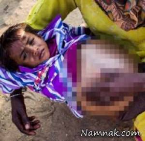 جراحی تومور سنگین شکم یک کودک