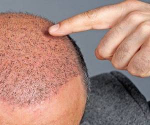 اصول شستشوی صحیح سر بعد از کاشت مو