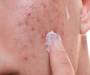 از جوش های بزرگ و ملتهب خود خسته شده اید؟&nbsp;