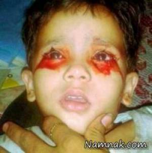 دختربچه 3 ساله هندی که هر روز از چشم ، دهان و گوشهایش خون جاری می شود
