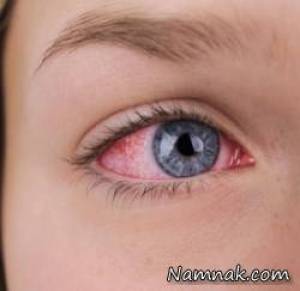 نابینای و کور شدن چشم یک مرد بر اثر انفجار مواد محترقه روی صورتش