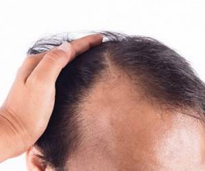تاثیر بی خوابی بر ریزش مو&nbsp;