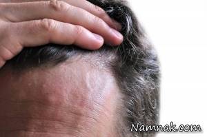 کتوکونازول و درمان شوره سر