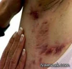 هیدرآدنیت چرکی چیست و چه طور درمان میشود