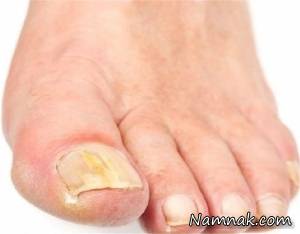 خطرات نادیده گرفتن قارچ ناخن
