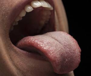آنچه باید از علل و علائم انواع سوختگی زبان و درمان آن بدانید