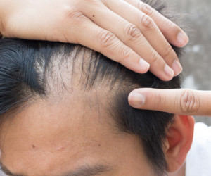 بررسی علل و راه حل ریزش مو در سنین پایین و نوجوانی