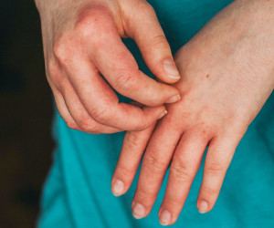 بررسی ارتباط اگزما و استرس