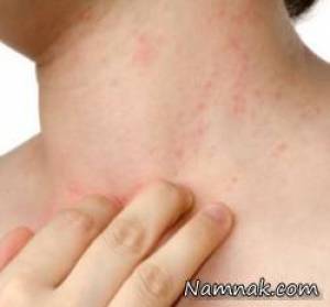 7 راه حل برای درمان جوش گرمازدگی