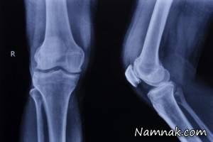مراقب خطرناک ترین شکستگی بدن تان باشید