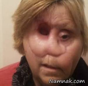 سرطان صورت زن 60 ساله را نابود کرد تا او بدن بینی و چشم شود