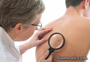 رابطه پرتوهای فرابنفش و سرطان پوست