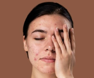 ماسک زیبایی صورت مخصوص نوجوان ها