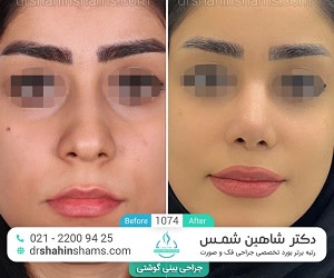 آشنایی با&nbsp;عمل زیبایی بینی