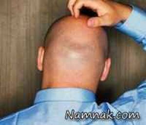 نکته ای مهم برای افراد طاس