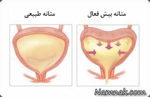 قدغن هایی برای مثانه بیش فعال