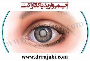 رپورتاژآگهی:آب مروارید