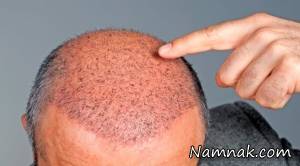 معرفی مراحل کاشت مو به روش&nbsp;FIT