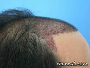کاشت مو به روش FUT
