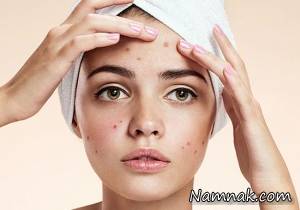 نکاتی درباره جوش صورت که از آن بی اطلاع هستید