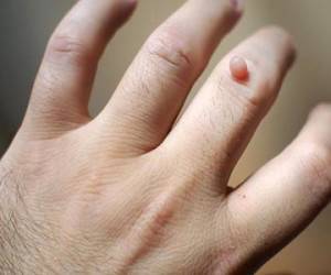 چرا زگیل خونریزی می کند؟