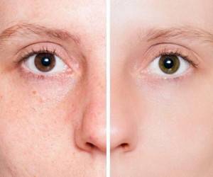 چگونه از هیدروژن پراکسید برای زیبایی پوست و درمان آکنه استفاده کنیم ؟