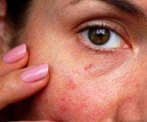 واریس صورت چیست و چطور درمان می شود؟
