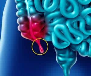 به دلایلی آپاندیس برای بدن مفید است&nbsp;