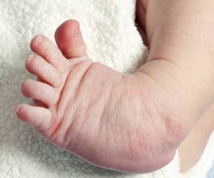 مشکلات و ناهنجاری های پا در نوزادان تازه متولد شده