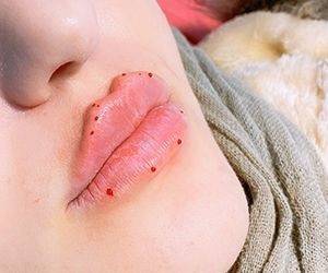 ماندگاری تزریق ژل لب چقدر هست؟