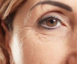 آشنایی با روش های برطف کردن چین و چروک صورت و چشم
