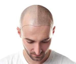 مقایسه دو روش اصلی کاشت و پیوند مو در طب مدرن